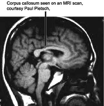 Corpus callosum